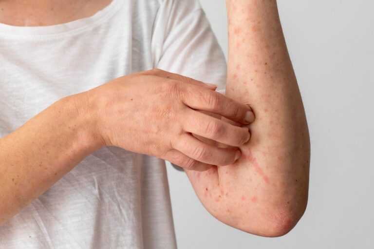 5 Eczema Diet Plans Which Can Be Helpful For Your Skin Issues